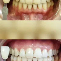 بلیچینگ IPS آلمان فقط تاپایان خرداد ۸تومان دوفک