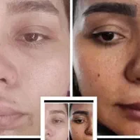 لیزر پاکسازی تتو روشن سازی تخصصی صورت و نواحی تیره|خدمات آرایشگری و زیبایی|قم, زنبیل آباد|دیوار
