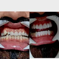 آموزش دندانسازی وکامپوزیت