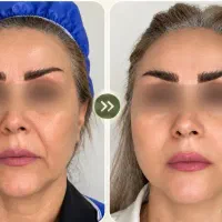 جراحی لیفت صورت، شقیقه چشم گربه‌ای ، پیشانی و ابرو