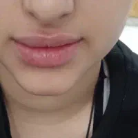 تزریق ژل و بوتاکس بصورت نقد و اقساط|خدمات آرایشگری و زیبایی|فولادشهر, ورزشگاه فولادشهر|دیوار