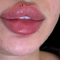 فیلرکل نواحی