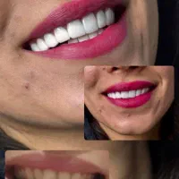 کامپوزیت و بلیچینگ با قیمت مناسب و کیفیت بالا|خدمات آرایشگری و زیبایی|اصفهان, سروستان|دیوار