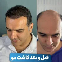 کاشت مو و ابرو|خدمات آرایشگری و زیبایی|رشت, بوسار|دیوار