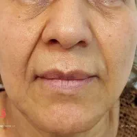 لیفت وجوانسازی قوی صورت|خدمات آرایشگری و زیبایی|رشت, گلسار|دیوار