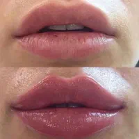 تزریق ژل وبوتاکس|خدمات آرایشگری و زیبایی|شیراز, ریشمک|دیوار