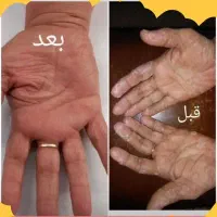 درمان مشکلات پوستی اگزما لک