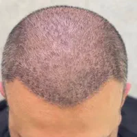 کاشت مو‌ و ابرو بصورت کاملا اقساطی