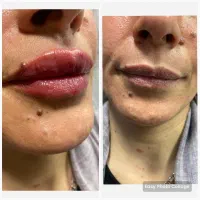 جشنواره تزریق ژل و بوتاکس در کلینیک فقط۶۰۰