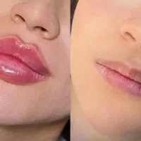 تخفیف 50 درصدی تزریق ژل و بوتاکس|خدمات آرایشگری و زیبایی|ارومیه, |دیوار