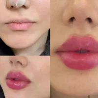 تزریق چربی،ژل،بوتاکس ونخ و مادلینگ تخصصی توسط پزشک|خدمات آرایشگری و زیبایی|کرمانشاه, |دیوار