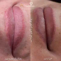 پاک کردن تاتوبالیزرکیوسوییچ|خدمات آرایشگری و زیبایی|مشهد, گلشور|دیوار