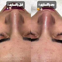 پاکسازی تخصصی پوست و لیفت ابرو