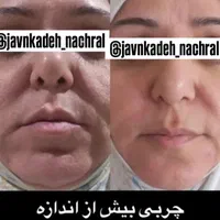 چین و چروک|آرایشی، بهداشتی، درمانی|تهران, جابری|دیوار