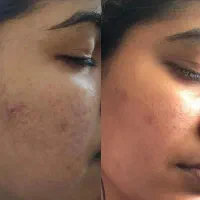 هنوزم دنبال رفع جوش هستی