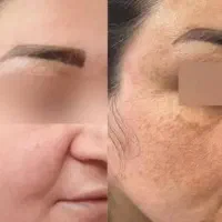 برداشتن خال وزگیل|خدمات آرایشگری و زیبایی|کرمانشاه, |دیوار