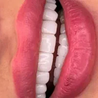 آموزش تخصصی کامپوزیت لمینت وروکش بلیچینگ