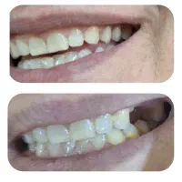 دندانسازی معین(ساخت دندان متحرک)