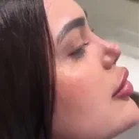 ۱۷ میلیون تخفیف جشنواره زمستانه جراحی بینی