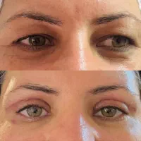 بلفاروپلاستی پلک بالا و پایین