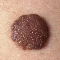 برداشتن خال زگیل گوشت اضاف برداشت زگیل تناسلی|خدمات آرایشگری و زیبایی|شیراز, معالی‌آباد|دیوار