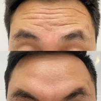 بوتاکس فقط برای آقایان