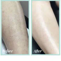 درمان کامل موبدن با لیزرالکس