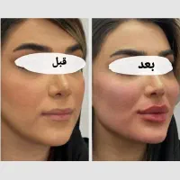 بوتاکس،فیلر،مادلینگ صورت،انواع جوانساز|خدمات آرایشگری و زیبایی|کرمانشاه, |دیوار