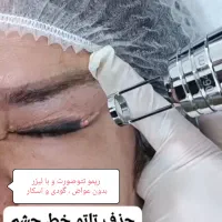 الکترولیزموی سفید، حذف تاتو،لیزرمو،خال برداری،کربن