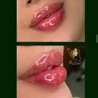 تزریق ژل وفیلر بادی و نخ و لیزر با دستگاه الکس۲۰۲۳|خدمات آرایشگری و زیبایی|تهران, تهرانپارس غربی|دیوار