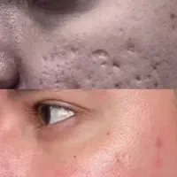 پاکسازی سوپرفشیال تخصصی، مطب ویژه آقایان وبانوان|خدمات زیبایی و سلامت|تهران, نارمک|دیوار