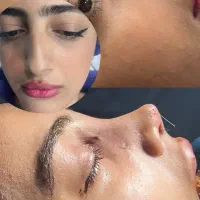 اف ویژه عمل بینی با ۴۰میلیون لیپو ۱۲۰در بیمارستان|خدمات زیبایی و سلامت|مشهد, احمدآباد|دیوار