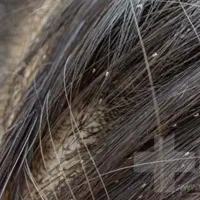 داروی رفع شپش وتخمک تضمینی تضمینی
