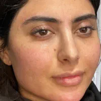 ژل و بوتاکس