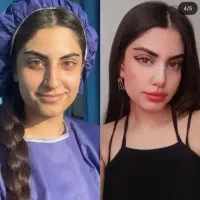 زیبایی/عمل/بینی/رینوپلاستی/جراحی بینی