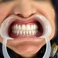 ساخت دندان مصنوعی با کم ترین قیمت|خدمات آرایشگری و زیبایی|تهران, جیحون|دیوار