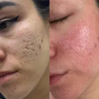 پاکسازی و فیشال /درمان جوش و لک و منافذباز|خدمات آرایشگری و زیبایی|کرمانشاه, |دیوار