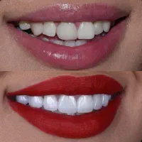 عصبکشی لمینت کامپوزیت جرمگیری کشیدن عقل بلیچینگ