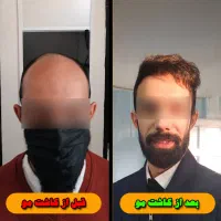 جشنواره یلدایی کاشت تخصصی مو و ابرو (شرایط اقساط)