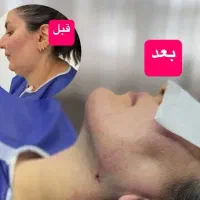 ساکشن غب غب،بوکال فت،سانترال لب