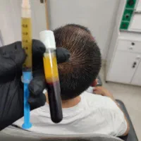 پی آر پی و  پی آر اف بوتاکس و مزوتراپی وهیرفیلر