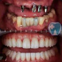 ایمپلنت کره ای 16/900 اقساط 12ماهه بدون پیش پرداخت