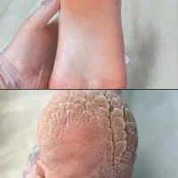 مدل برای پدیکور تضمینی