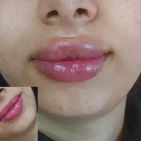 تزریق ژل ،فیلر بوتاکس مزو آنزیم خال برداری|خدمات آرایشگری و زیبایی|الیگودرز, |دیوار