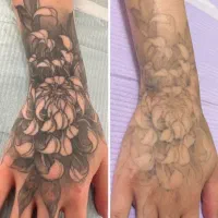 لیزر تتو / ریموو تک جلسه‌ ای