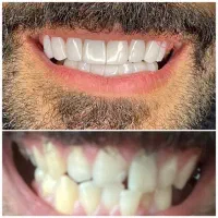 کامپوزیت و سفید سازی دندان  اقساطی
