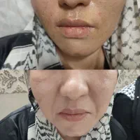 لیزر خال /میخچه زگیل/ ژل بوتاکس|خدمات آرایشگری و زیبایی|قم, صفائیه|دیوار