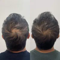 کاشت بدرد نمیخوره