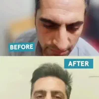 کاشت مو|خدمات آرایشگری و زیبایی|کرمانشاه, |دیوار