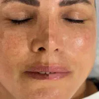 دستگاه کربن تراپی روشن کننده و از بین برنده تاتو